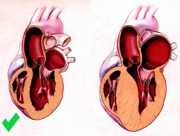 Cardione zabraňuje ventrikulární hypertrofii srdce